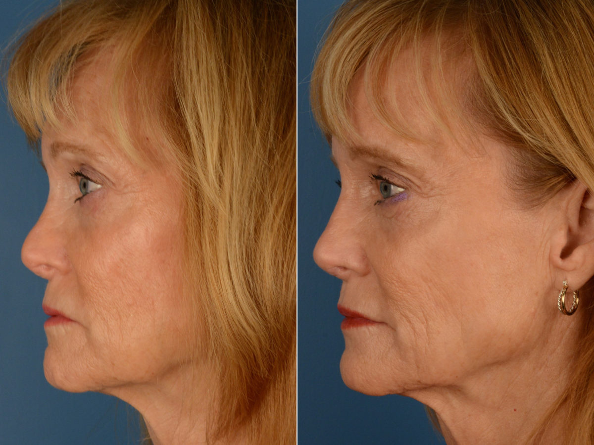 Revision Rhinoplasty Photos Page 2 Of 3 Aesthetic